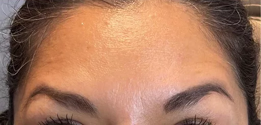 Csomag - Szilikon ránctalanító tapaszok – SZEM + HOMLOK