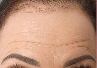 Bőrápolás a LUMINE tapaszok használata előtt