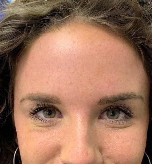 Bőr a LUMINE tapaszok használata után