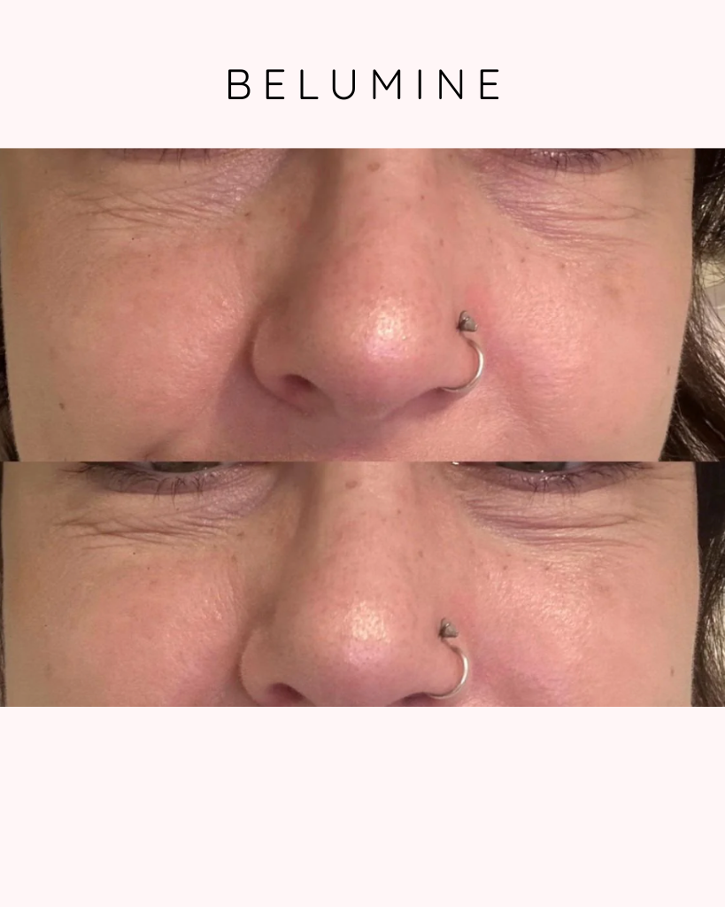 Szilikon szemtapasz ráncok ellen