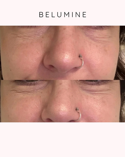 Szilikon szemtapasz ráncok ellen