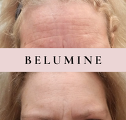 Szemöldökráncokra való szilikon tapasz