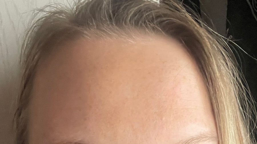 Bőr a LUMINE tapaszok használata után