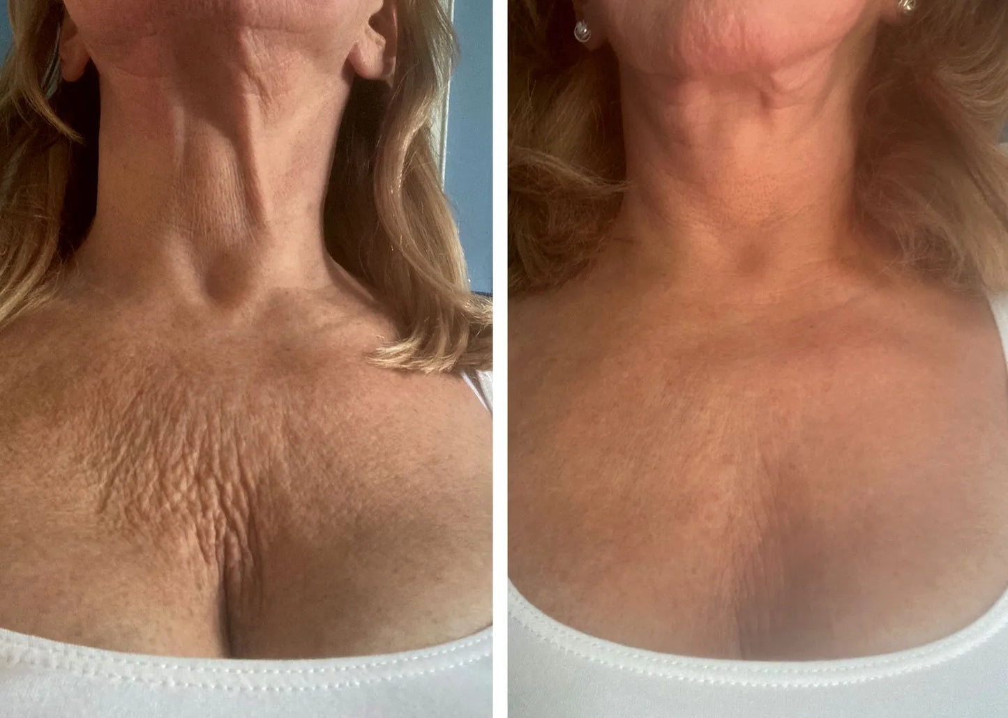 Szilikon tapasz a mellkasi ráncok ellen